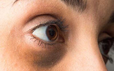 Dark Circles? Everything You Need To Know About Under-Eye Filler