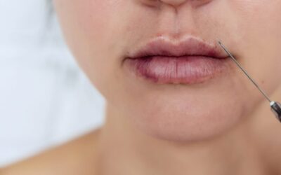 Bruising After Filler Injections